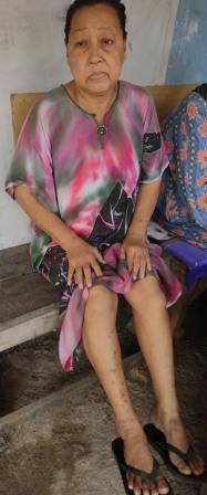 Mak Cik Ane mperlihatkan kakinya yang berkudis akibat limbah penampungan besi tua di Tanjung Unggat.